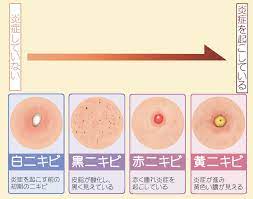 お肌のトラブル　part①