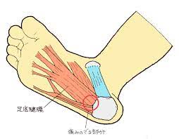 立ち仕事で足底腱膜炎？