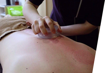 カッピング 治療とは