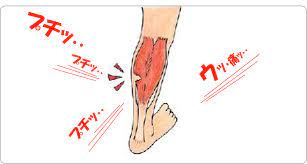 サッカー中に肉離れ？