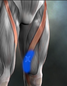 トリガーポイント　part.1