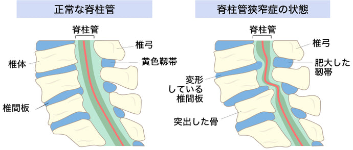 【脊柱管狭窄症】による腰痛について