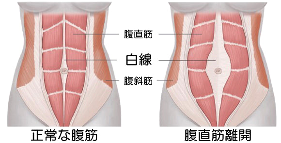 産後のぽっこりおなかの原因は？