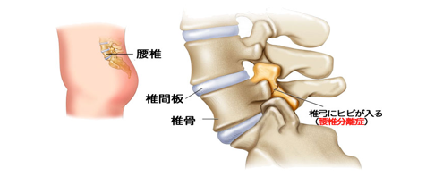 バレーボール腰椎分離症について